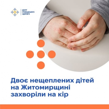Двоє нещеплених дітей на Житомирщині захворіли на кір