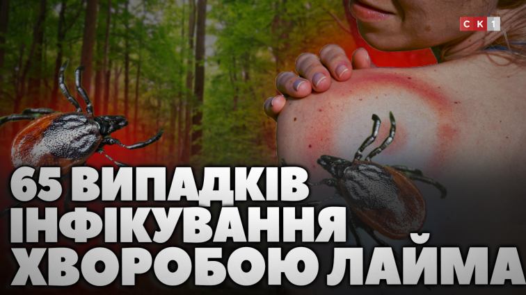 На Житомирщині зафіксували 65 випадків інфікування хворобою Лайма: як вберегти себе від укусу кліща? (ВІДЕО)