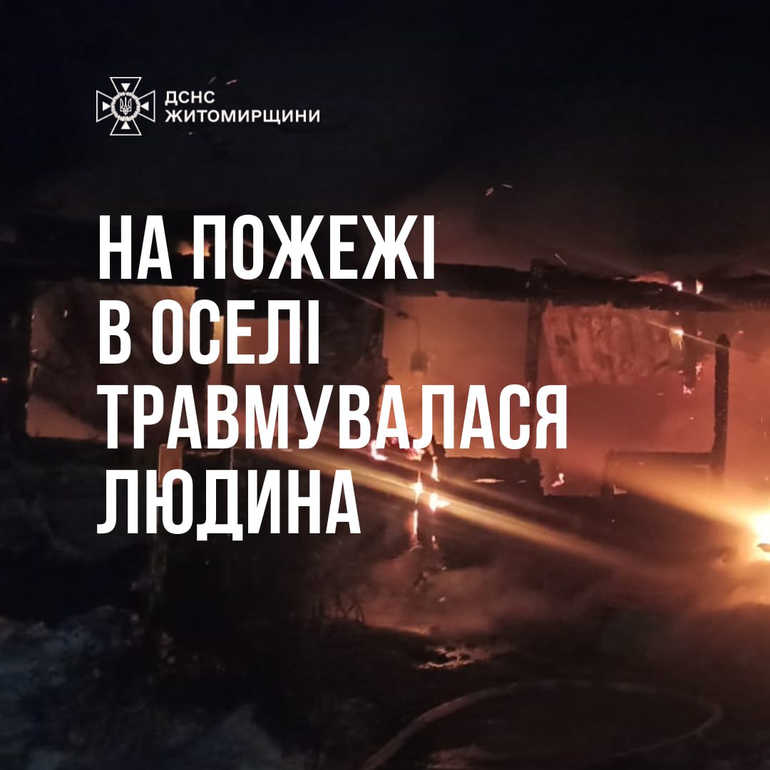 У Звягельському районі під час пожежі у будинку травмувалася людина